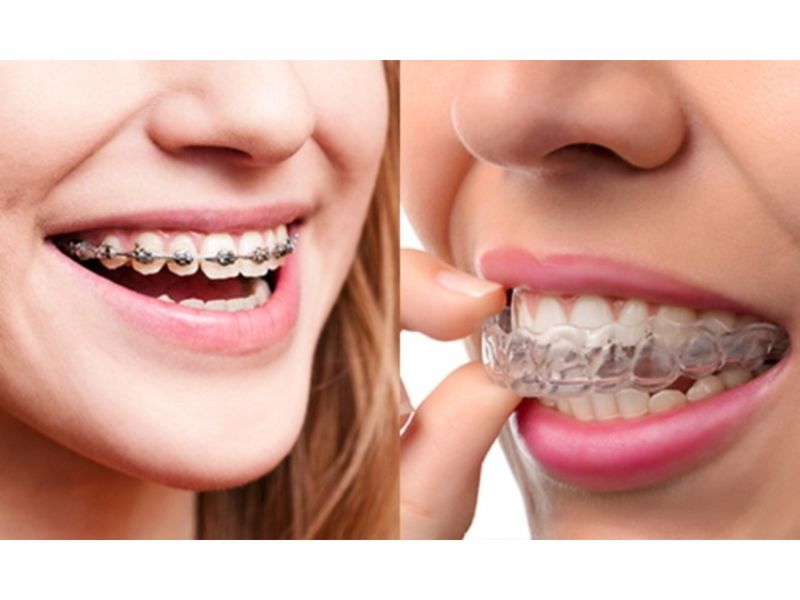 Metal Braces Vs Plastic Trays